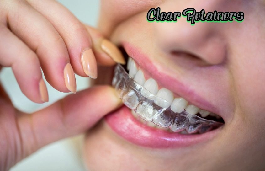 Clear Retainers